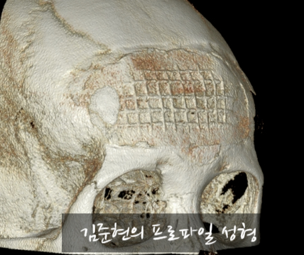 I Removed Two Forehead Implants. A Board-Certified Plastic Surgeon Explains Why I Do Not Recommend Forehead Implants. image 19