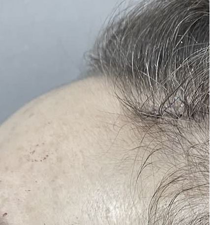 Headache, vomiting, pain, nausea after forehead lift... is it a side effect?! Here's my answer. image 10
