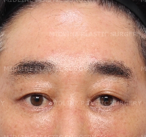 Endoscopic forehead lift that removes wrinkles and creates natural forehead volume! image 6