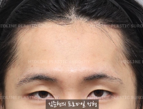 눈썹뼈절삭, 어떨 때 어떻게 하는 수술일까요? 꼭 이마거상과 함께 해야만 하는 수술인가요? 미드라인성형외과에서 하는 눈썹뼈절삭 수술을 설명드립니다. (3D CT 있음) 관련 이미지 11