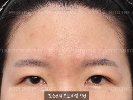 Because of the Mongolian fold, the eyes look cramped — epicanthoplasty can fix it. (Feat. Endoscopic forehead lift) image 10