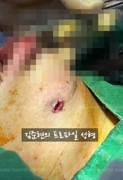 앞턱 보형물이 턱 옆으로 뚫고 나와요ㅠㅠ앞턱 보형물 제거 후 턱끝전진술을 한 케이스를 성형외과 전문의가 설명합니다. 관련 이미지 11