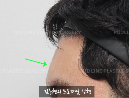 Let’s Learn About the Effects of Brow Bone Reduction Surgery. (Brow Bone? Eye Hole Bone? Here’s a Terminology Guide.) image 24