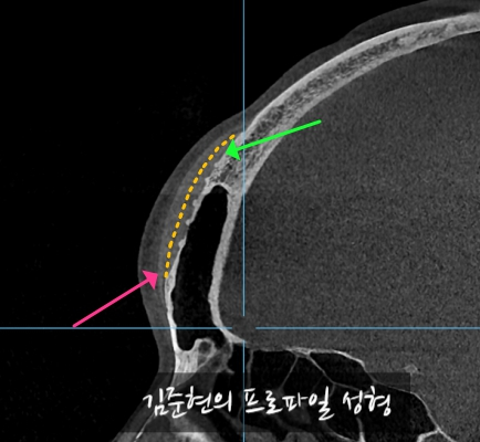 I Removed Two Forehead Implants. A Board-Certified Plastic Surgeon Explains Why I Do Not Recommend Forehead Implants. image 6