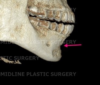 A Specialist Explains Chin Advancement Surgery After Removal of a Receded Chin Implant image 6