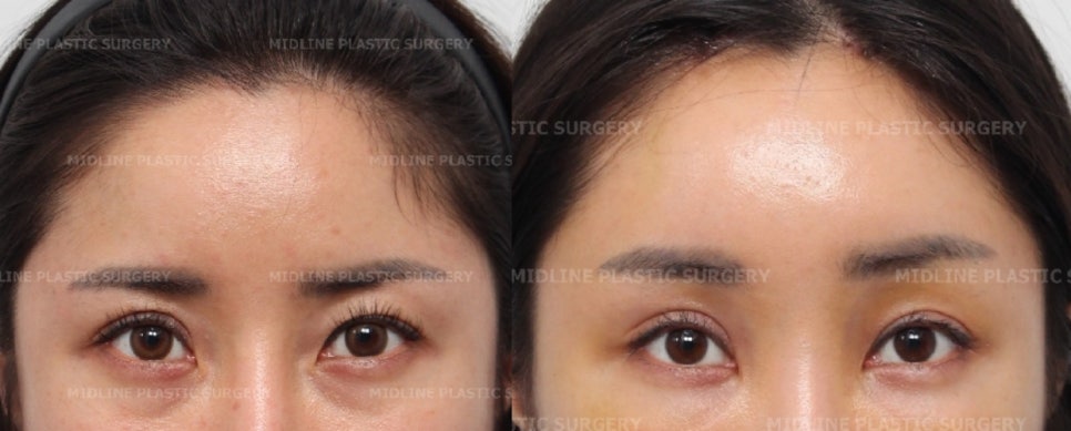 I want to remove my forehead implant because it makes my forehead look too voluminous, and I also want a forehead lift at the same time. (Feat. under-eye fat repositioning + fat grafting) image 7