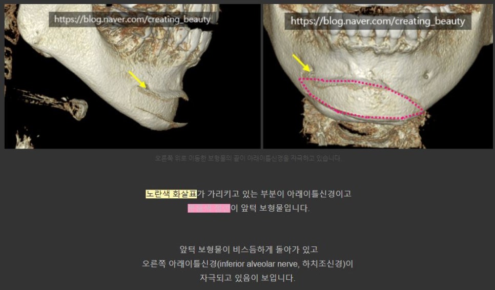 필러&middot;보형물 부작용, 골흡수 됐을 때 해결 방법은? 관련 이미지 11