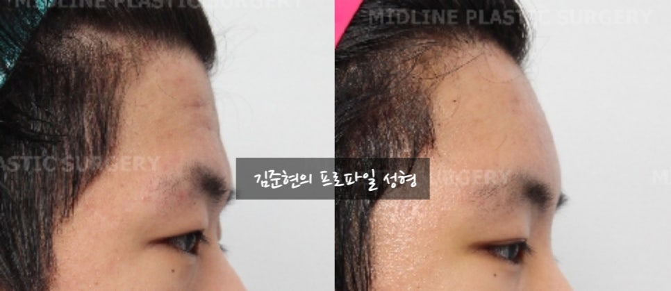 How Can Deep Forehead Wrinkles Be Resolved? (Feat. Forehead Lift + Filler) image 13