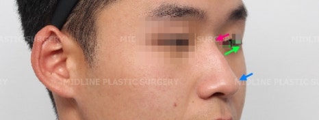 휜 코, 매부리 교정과 기능코-비중격만곡증까지 바로잡기 관련 이미지 7