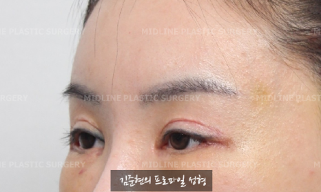 The outer corners of my eyes are open and my eyes stingㅠㅠI had lateral canthoplasty revision and eye corner restoration.(feat. Endoscopic forehead lift) image 12