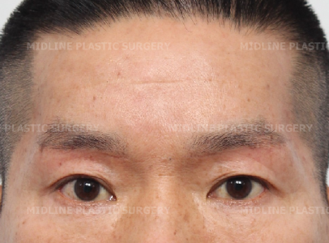 When Should Endoscopic Forehead Lift and Brow Lift Be Performed at the Same Time? (Feat. Lower Blepharoplasty) image 9