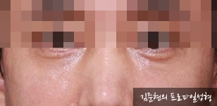 성형외과 전문의가 눈밑수술 케이스의 진단방법 및 나이들면 하는 수술이다라는 오해에 대해 설명해드립니다. 관련 이미지 2