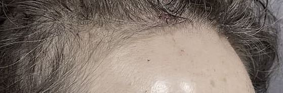 Headache, vomiting, pain, nausea after forehead lift... is it a side effect?! Here's my answer. image 11