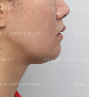 A Plastic Surgeon Explains the Changes in the Front and Side Views After Reduction Genioplasty and Advancement Genioplasty. (Feat. Rhinoplasty) image 2