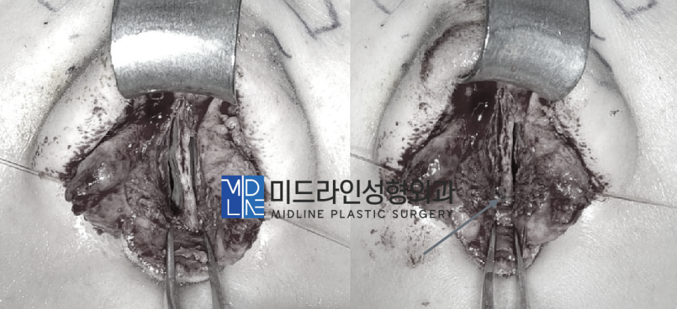 The Plastic Surgery Specialist Explains Septoplasty, One of the Methods for Functional Nose Surgery for Rhinitis. (feat. Swing-door Technique) image 7