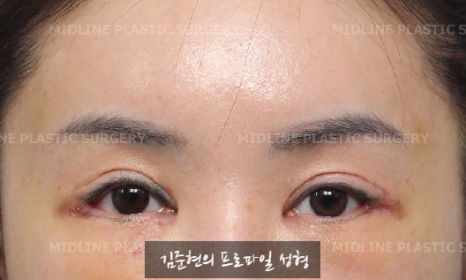 The outer corners of my eyes are open and my eyes stingㅠㅠI had lateral canthoplasty revision and eye corner restoration.(feat. Endoscopic forehead lift) image 8