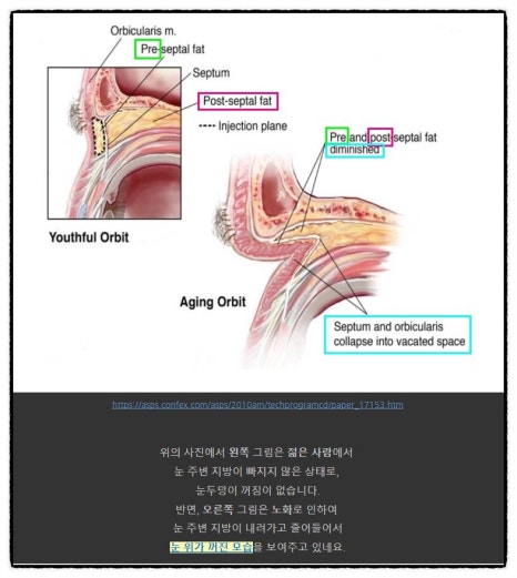 Sallow Eyes, Sunken Eyes Solved with Fat Grafting! (Feat. Dark Circles) image 4