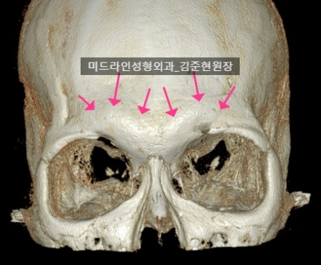 눈썹뼈 절삭에 관하여 (안와상융기) 관련 이미지 2