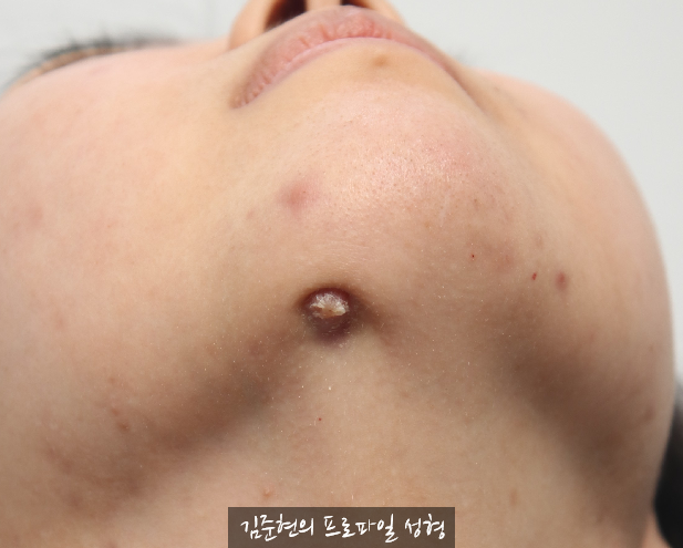 앞턱 보형물이 턱 아래로 뚫고 나와요..ㅠㅠ 앞턱 보형물 제거 후 턱끝 전진술한 경우를 성형외과 전문의가 설명드립니다. 관련 이미지 5