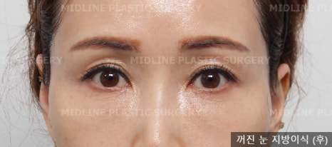 Sallow Eyes, Sunken Eyes Solved with Fat Grafting! (Feat. Dark Circles) image 10