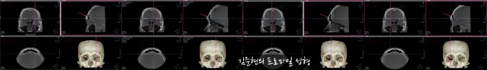 눈썹뼈절삭, 어떨 때 어떻게 하는 수술일까요? 꼭 이마거상과 함께 해야만 하는 수술인가요? 미드라인성형외과에서 하는 눈썹뼈절삭 수술을 설명드립니다. (3D CT 있음) 관련 이미지 17