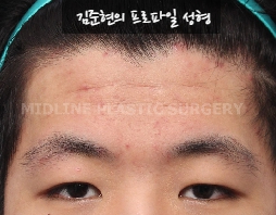 How Can Deep Forehead Wrinkles Be Resolved? (Feat. Forehead Lift + Filler) image 1