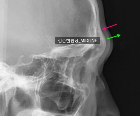 Forehead Lift for a Forehead with Prominent Brow Bones?? image 14