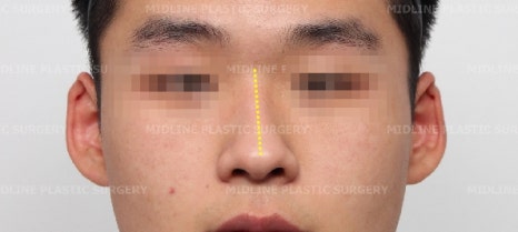 휜 코, 매부리 교정과 기능코-비중격만곡증까지 바로잡기 관련 이미지 22