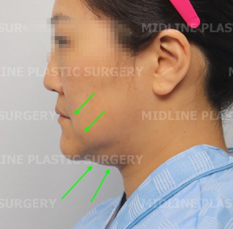 About Face Lifts That Are Effective for Improving Mouth Corners, Neck Wrinkles, and Cheek Sagging image 3
