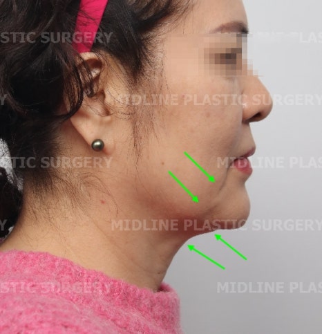 About Face Lifts That Are Effective for Improving Mouth Corners, Neck Wrinkles, and Cheek Sagging image 2