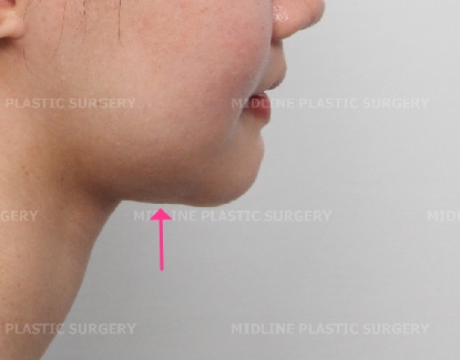 Fixing a Sagging Double Chin After Contouring Surgery! Let’s Learn About Mid-Up Lifting 2040. image 12