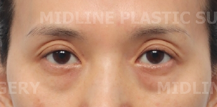 눈두덩이 꺼짐을 해결할 수 있는 눈꺼풀 지방이식! 성형외과 전문의가 설명드립니다. 관련 이미지 15