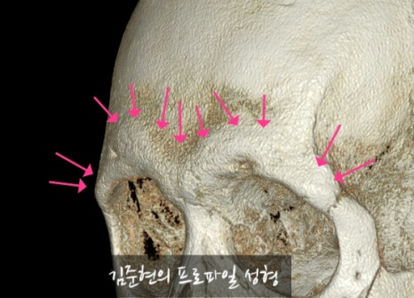 Let’s Learn About the Effects of Brow Bone Reduction Surgery. (Brow Bone? Eye Hole Bone? Here’s a Terminology Guide.) image 18