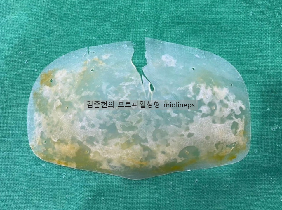 이마보형물. 권하지 않는 이유를 성형외과 전문의가 설명해 드립니다. 관련 이미지 1
