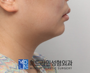 A Plastic Surgery Specialist Explains Why Chin Liposuction Is Sometimes Essential Because Jaw Reduction Surgery Alone Has Limited Effect image 2