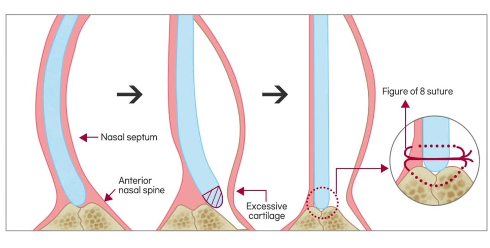 The Plastic Surgery Specialist Explains Septoplasty, One of the Methods for Functional Nose Surgery for Rhinitis. (feat. Swing-door Technique) image 4