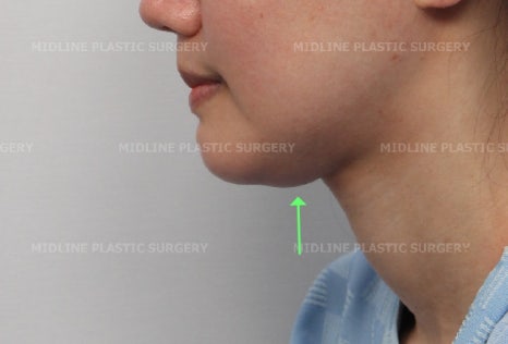 Fixing a Sagging Double Chin After Contouring Surgery! Let’s Learn About Mid-Up Lifting 2040. image 15