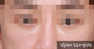 성형외과 전문의가 눈밑수술 케이스의 진단방법 및 나이들면 하는 수술이다라는 오해에 대해 설명해드립니다. 관련 이미지 10