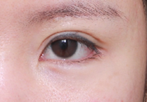 What Type of Plastic Surgery Is Needed for Small, Cramped Eyes? (About Lateral, Lower, and Combined Lateral-Lower Canthoplasty) image 6