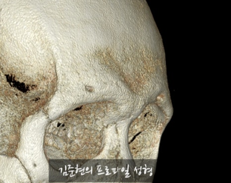 Let’s Learn About the Effects of Brow Bone Reduction Surgery. (Brow Bone? Eye Hole Bone? Here’s a Terminology Guide.) image 6