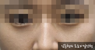 성형외과 전문의가 눈밑수술 케이스의 진단방법 및 나이들면 하는 수술이다라는 오해에 대해 설명해드립니다. 관련 이미지 6