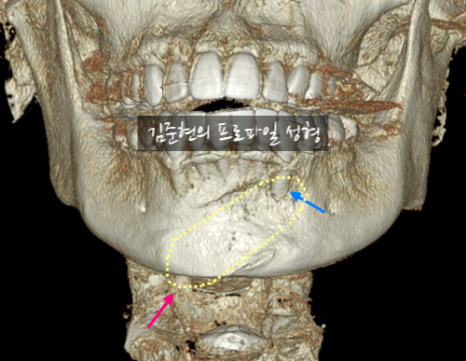 앞턱 보형물이 턱 아래로 뚫고 나와요..ㅠㅠ 앞턱 보형물 제거 후 턱끝 전진술한 경우를 성형외과 전문의가 설명드립니다. 관련 이미지 4