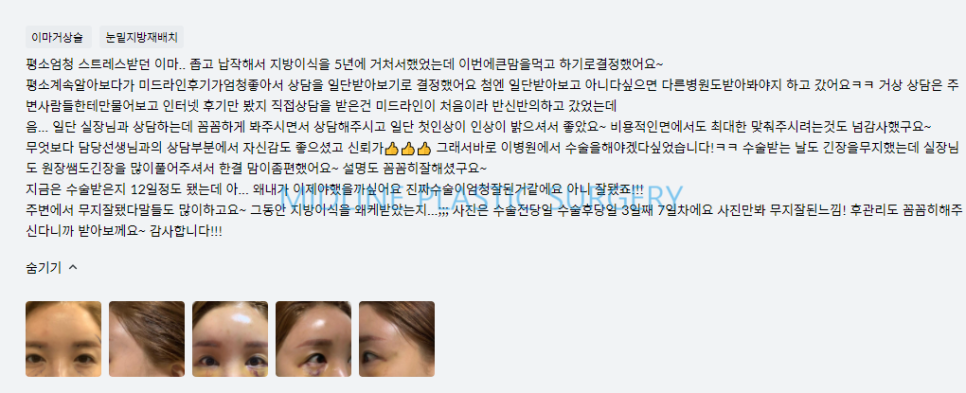 Forehead Lift! Endotine vs Absorbable Thread — Explaining the Differences in Results and Side Effects image 17