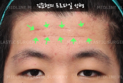 How Can Deep Forehead Wrinkles Be Resolved? (Feat. Forehead Lift + Filler) image 6