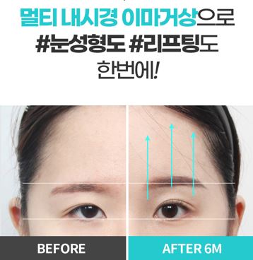 멀티 내시경이마거상술 vs 일반 이마거상술 차이점! 관련 이미지 4
