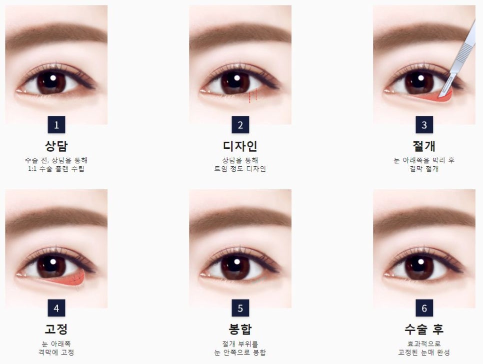 What Type of Plastic Surgery Is Needed for Small, Cramped Eyes? (About Lateral, Lower, and Combined Lateral-Lower Canthoplasty) image 4