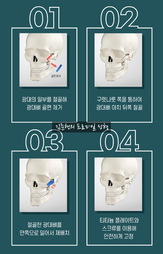 45도 광대와 옆광대를 모두 줄이는 광대축소술을 성형외과 전문의가 알려드립니다. 관련 이미지 6