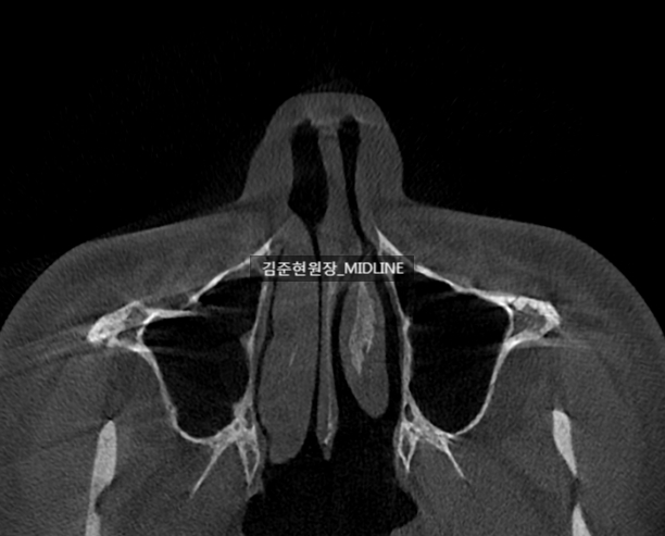 휜 코, 매부리 교정과 기능코-비중격만곡증까지 바로잡기 관련 이미지 10