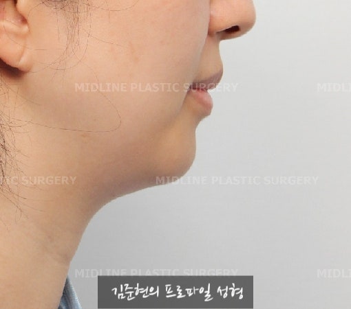 이중턱이 고민이에요ㅠㅠ숨은 턱선을 찾아주는 이중턱, 턱라인 지방흡입! 미드업 2040에 관하여 설명드립니다. 관련 이미지 6