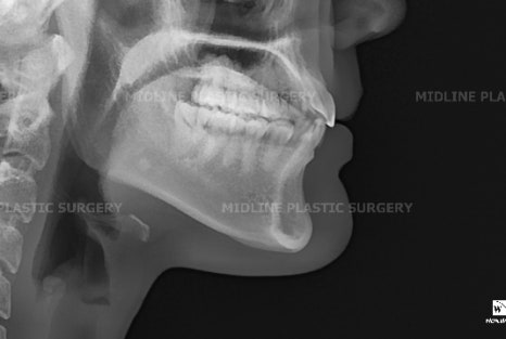 Fixing a Sagging Double Chin After Contouring Surgery! Let’s Learn About Mid-Up Lifting 2040. image 3